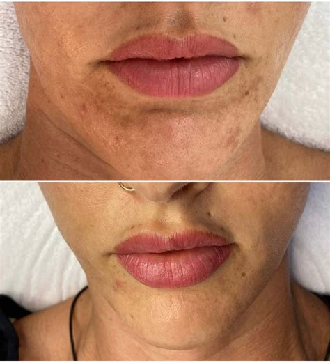 Venus Viva Resurfacing .